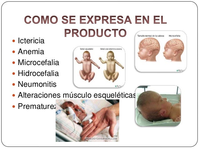 sindrome de torch